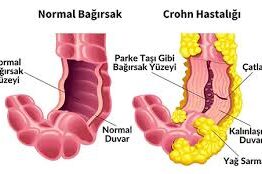 Crohn Hastalığı Nedir ve Tedavi Yöntemleri